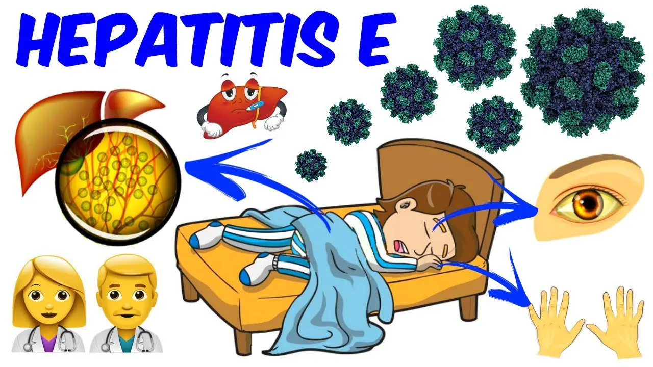 Hepatitis A Causes Symptoms Treatments And More