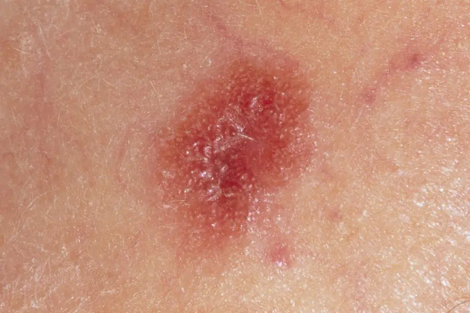 early-malignant-melanoma-in-situ