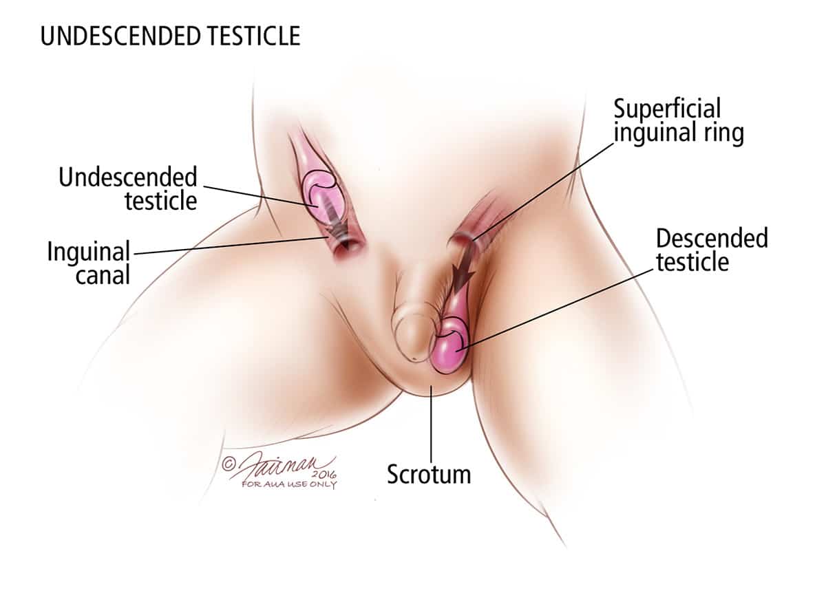 Cryptorchidism (Undescended Testicles): Symptoms and Causes