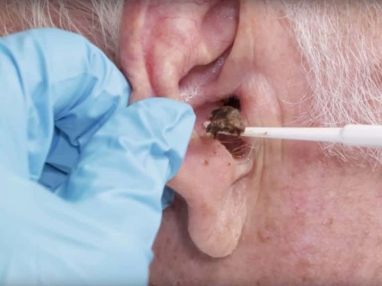 urgent care ear wax removal